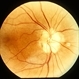 Optic Nerve Head Drusen